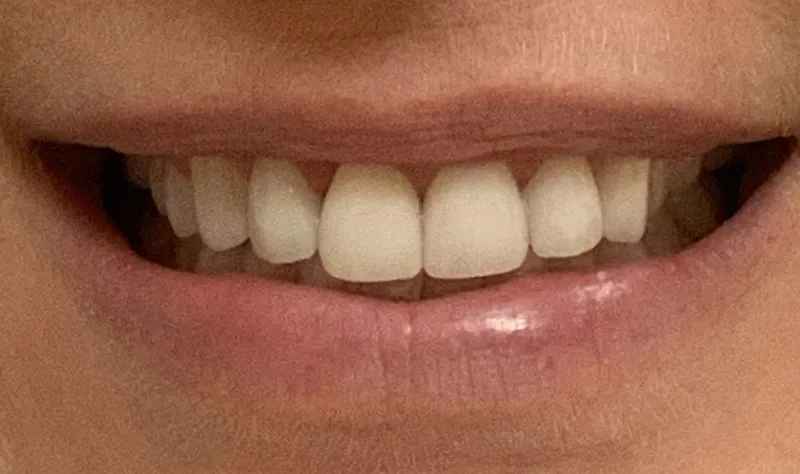 after veneers