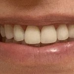 after veneers