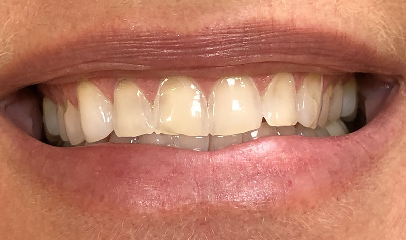 before veneers
