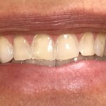before veneers